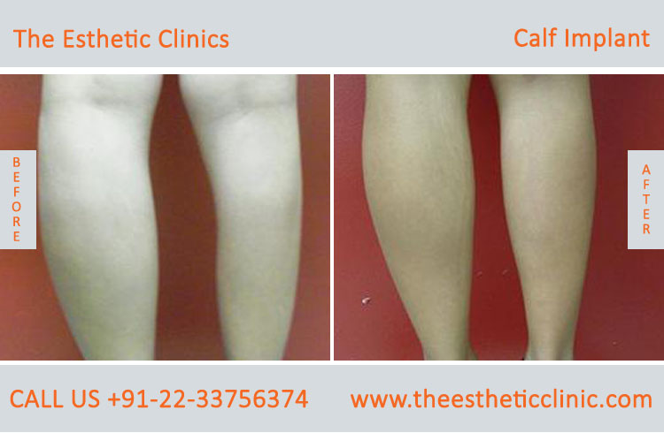 Calf implants, Calf Augmentation surgery before after photos in mumbai india (3)